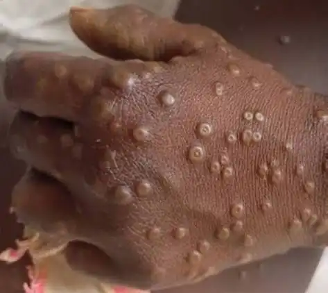 Western Equatoria Battles Rising Mpox Cases Amid Medical Shortages and Ebola Fears